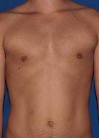 Gynecomastia After