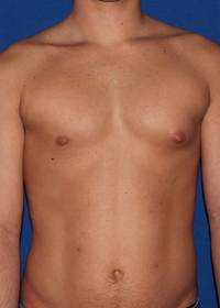 Gynecomastia Before