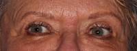 Upper Blepharoplasty After
