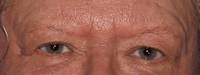 Upper Blepharoplasty Before