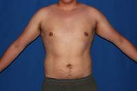 Gynecomastia After