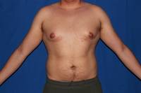 Gynecomastia Before
