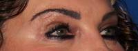 Scottsdale Blepharoplasty after