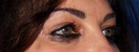Scottsdale Blepharoplasty Before