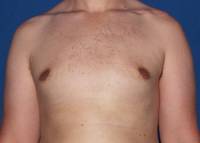 Gynecomastia after