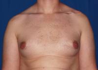 Gynecomastia Before