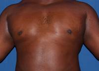 Gynecomastia after
