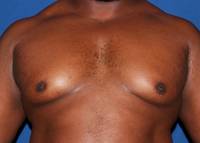 Gynecomastia Before