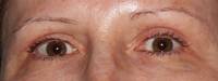 Upper Eyelid Surgery After
