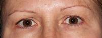 Upper Eyelid Surgery Before