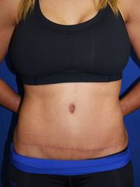 tummy tuck after