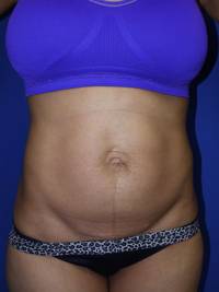 tummy tuck before
