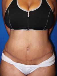 After weight loss surgery