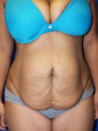 Before weight loss surgery