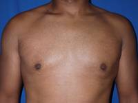 gynecomastia after
