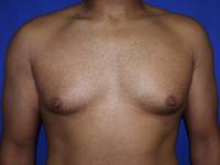 gynecomastia before