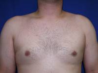 One Stitch Gynecomastia after