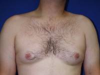 One Stitch Gynecomastia Before