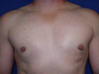 Gynecomastia after