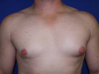 Gynecomastia Before