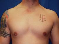 One Stitch Gynecomastia AFter
