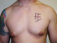 One Stitch Gynecomastia Before