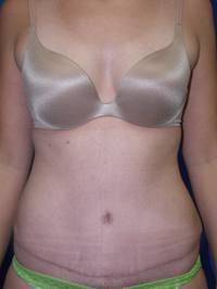 Tummy Tuck AFter