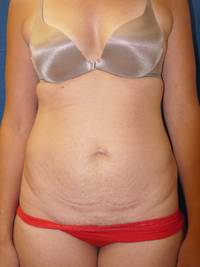 Tummy Tuck Before