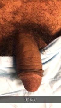 Scottsdale Male Enhancement with Fillers Before