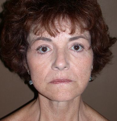 After Face Lift with Eyelid Surgery by Dr. Bermudez in San Francisco