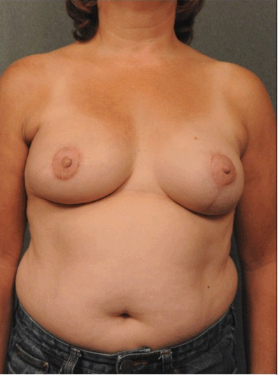 before and after