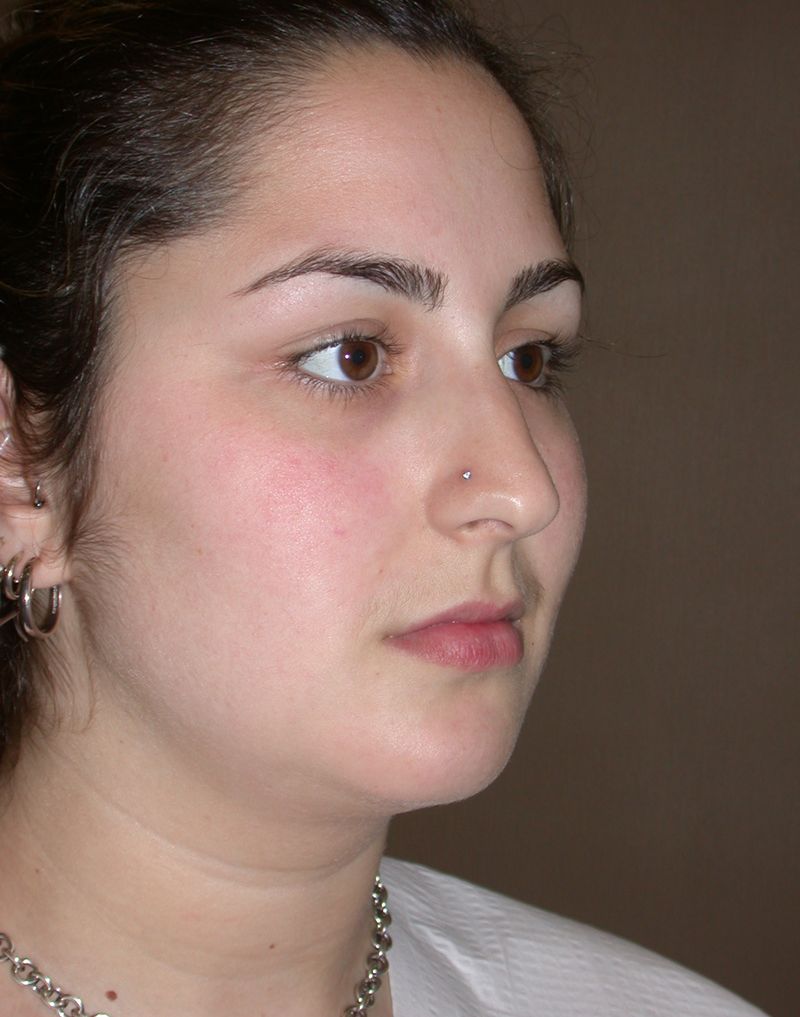 Before Nose Job Surgery by Dr. Bermudez in San Francisco