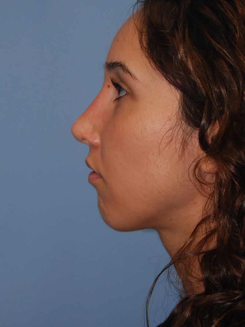After Nose Job Surgery by Dr. Bermudez in San Francisco