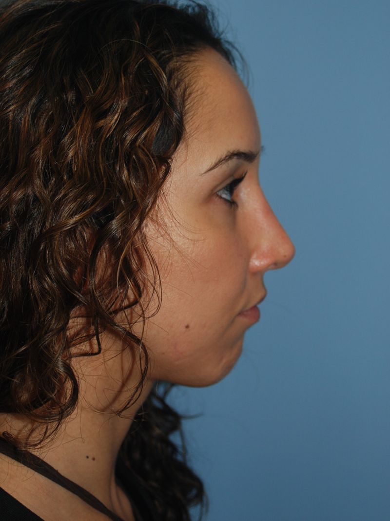 After Nose Job Surgery by Dr. Bermudez in San Francisco