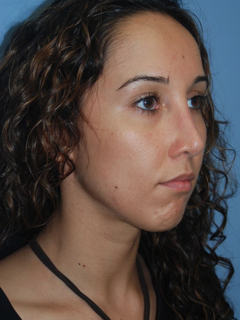 After Nose Job Surgery by Dr. Bermudez in San Francisco