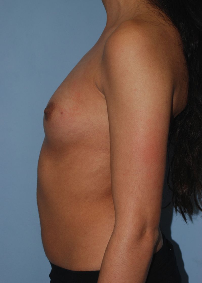 Before Breast Augmentation with Breast Implants by Dr. Bermudez