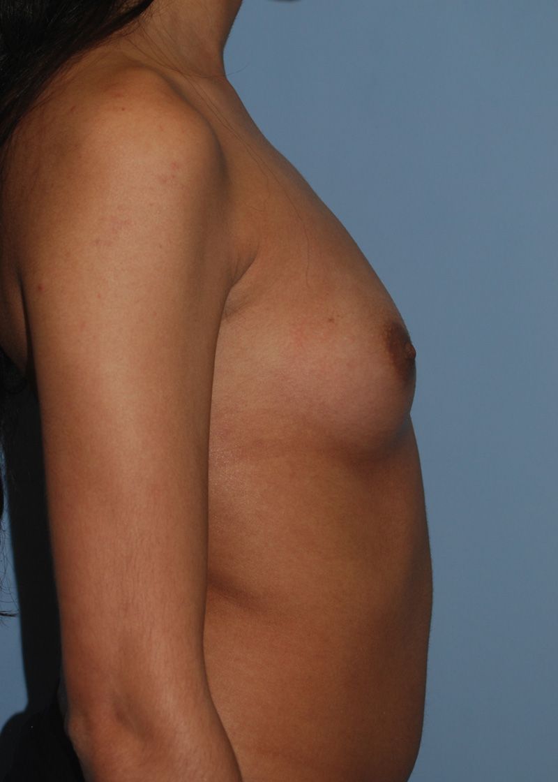 Before Breast Augmentation with Breast Implants by Dr. Bermudez