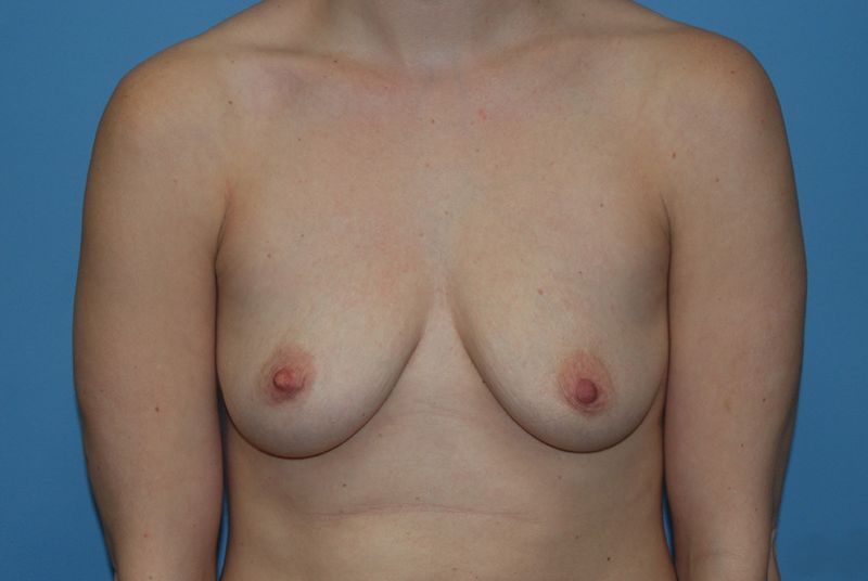 Before Breast Augmentation with Fat Grafting by Dr. Bermudez