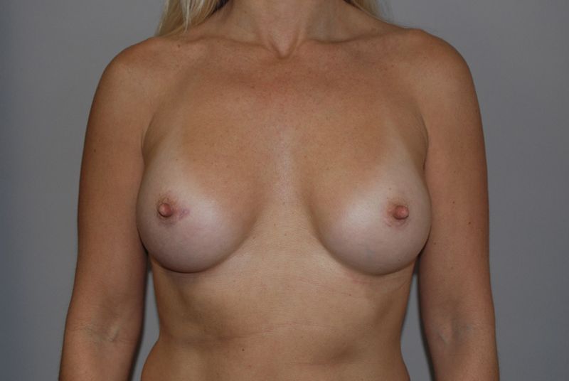 After Breast Augmentation with Breast Implants by Dr. Bermudez