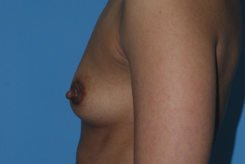 Before Breast Augmentation with Breast Implants by Dr. Bermudez