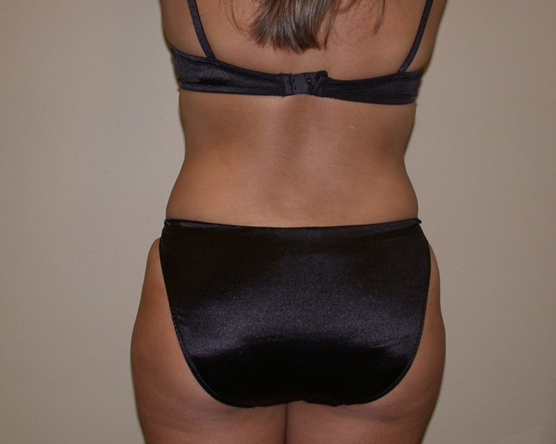 After Abdominoplasty by Dr. Bermudez