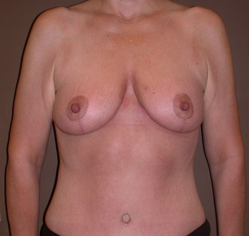 After Breast Lift by Dr. Bermudez