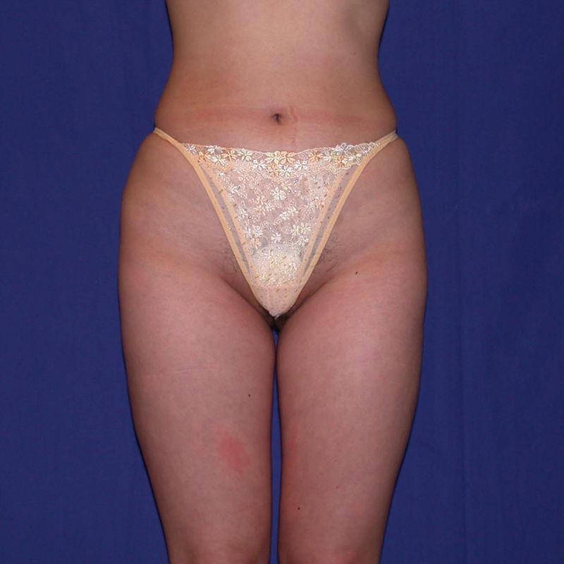 After Liposuction by Dr. Bermudez