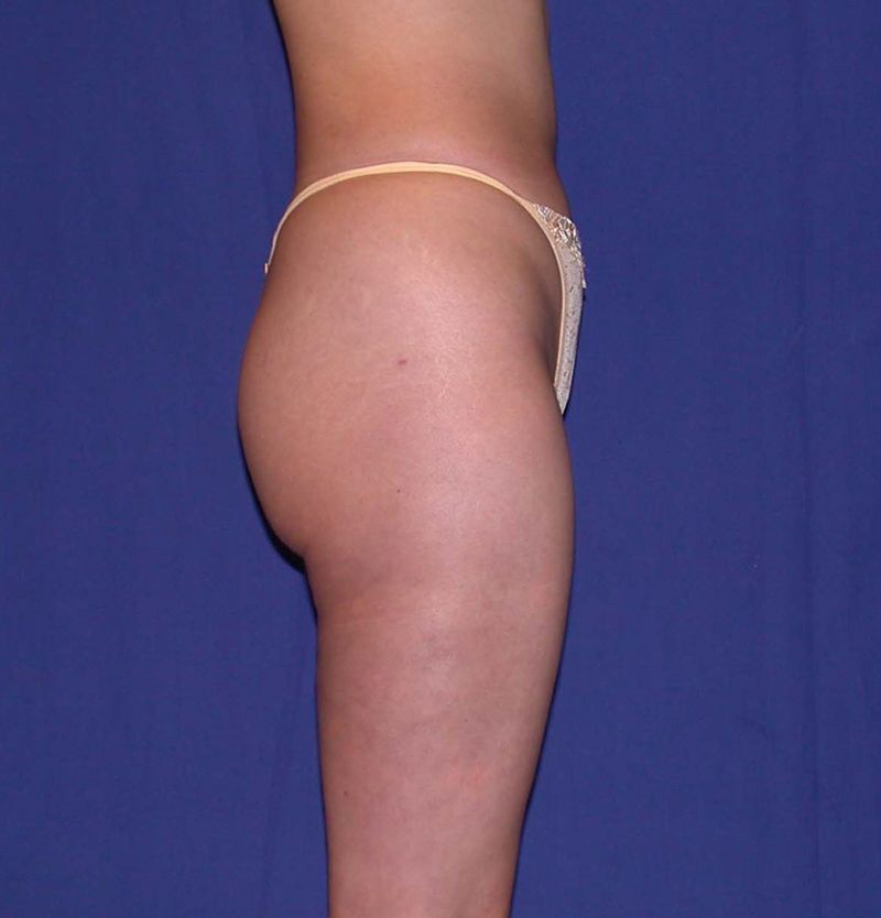 After Liposuction by Dr. Bermudez