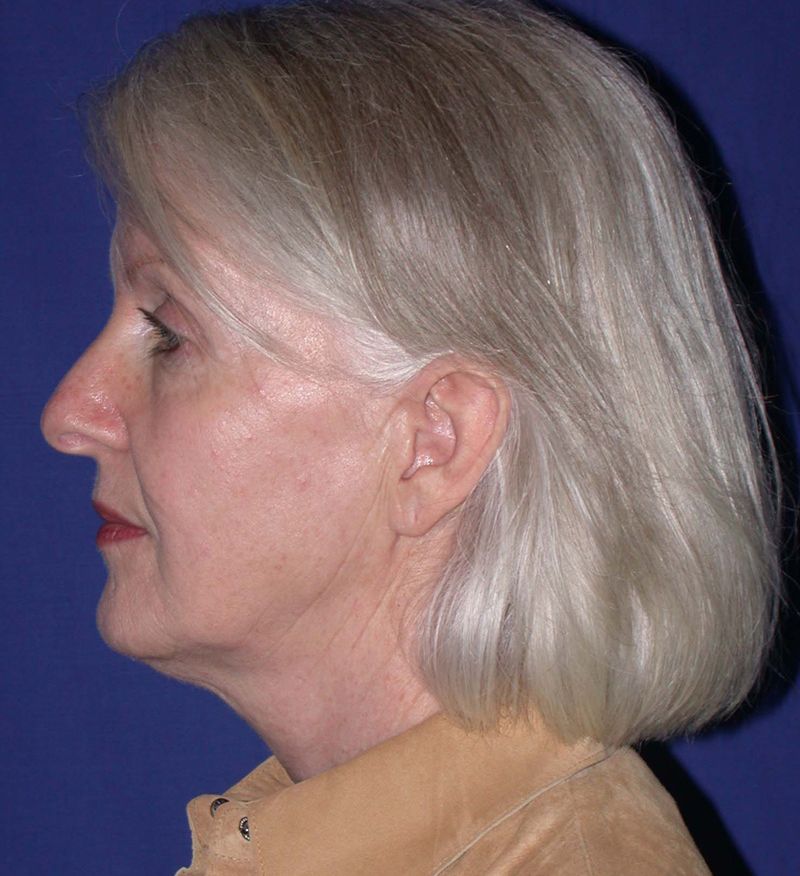 Before Face Lift Surgery by Dr. Bermudez in San Francisco