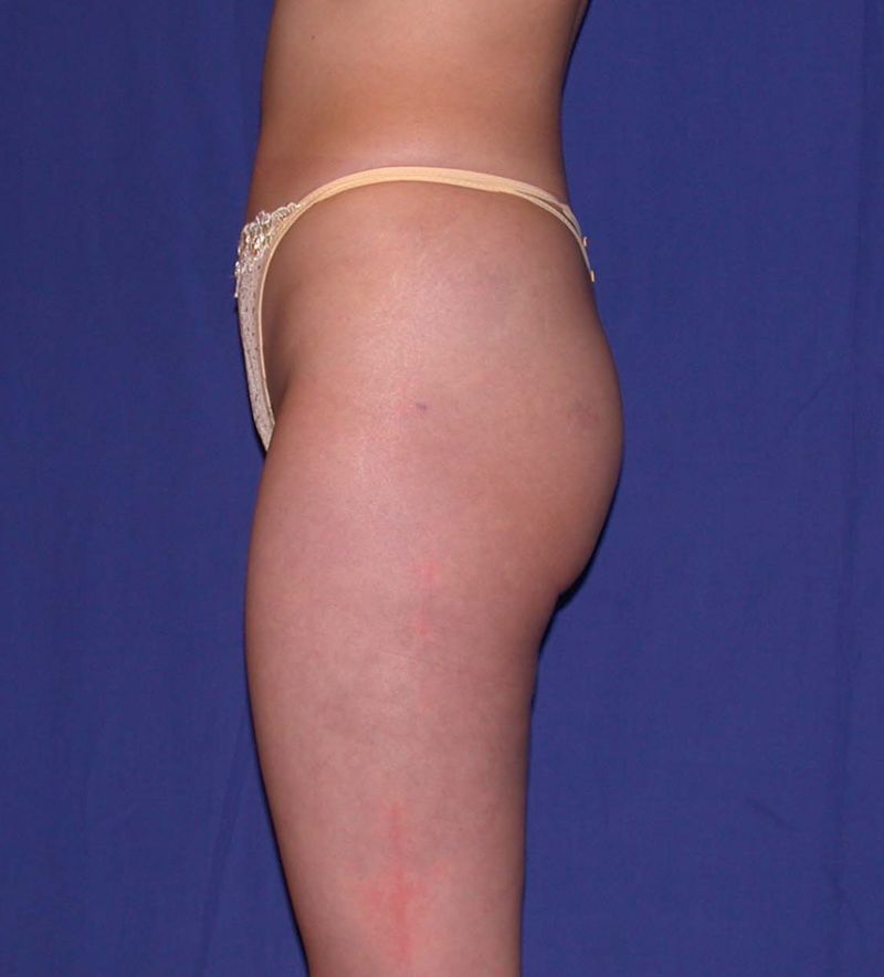After Liposuction by Dr. Bermudez