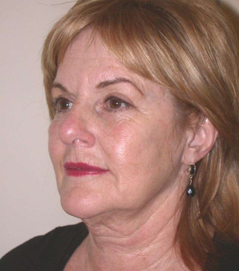 Before Face Lift with Lip Filler by Dr. Bermudez in San Francisco