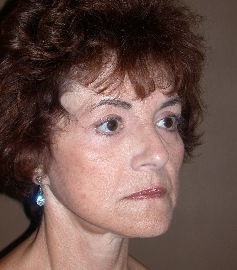 After Face Lift with Eyelid Surgery by Dr. Bermudez in San Francisco