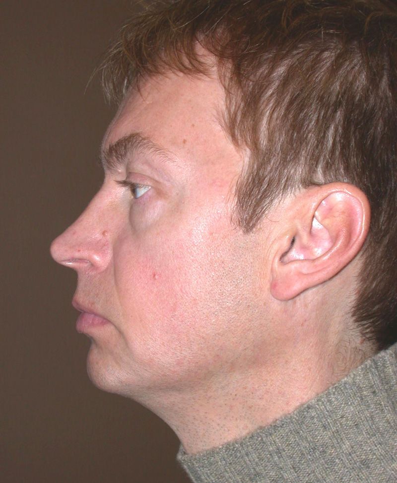Before Nose Job Surgery by Dr. Bermudez in San Francisco