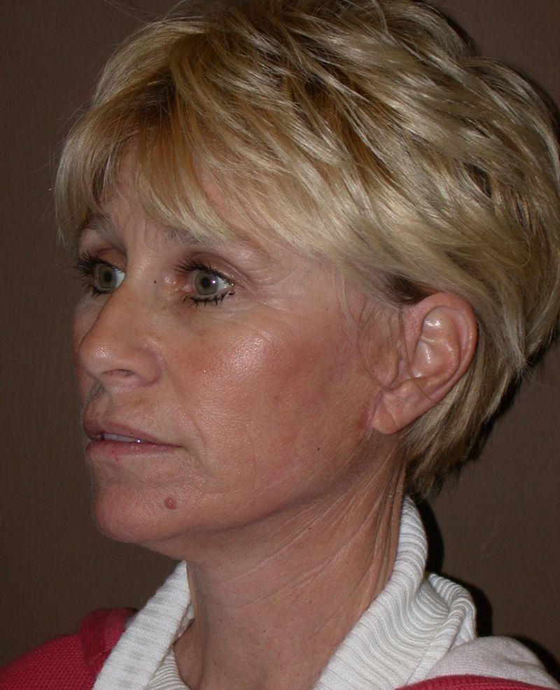 After Face Lift with Lip Filler by Dr. Bermudez in San Francisco